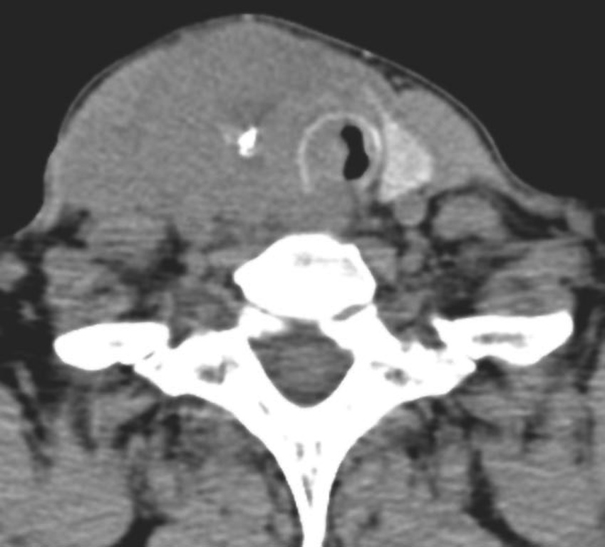 Pathology Outlines Anaplastic carcinoma